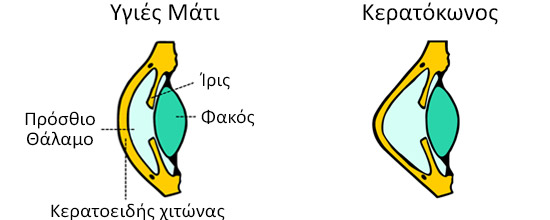 Στον κερατόκωνο το κανονικό σχήμα του κερατοειδής αρχίζει να λεπταίνει κεντρικά ή παρακεντρικά.