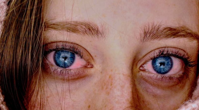 Επιπεφυκίτιδα - Μια πάθηση των οφθαλμών γνωστή ως ‘κόκκινο μάτι
