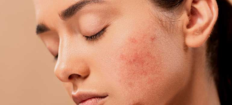 Σημάδια ακμής